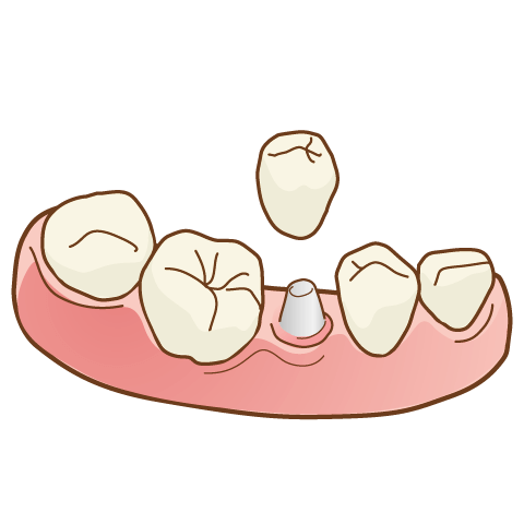 インプラント