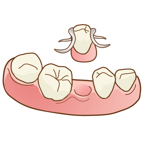 入れ歯（部分）