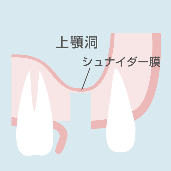 ソケットリフト手順2