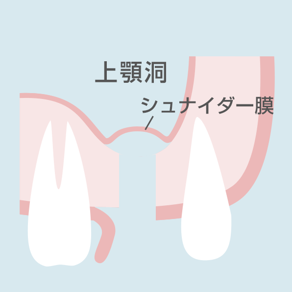 ソケットリフト手順3