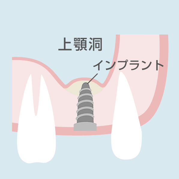 ソケットリフト手順6